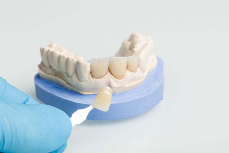 Descubre los diferentes tipo de carillas dentales que hay